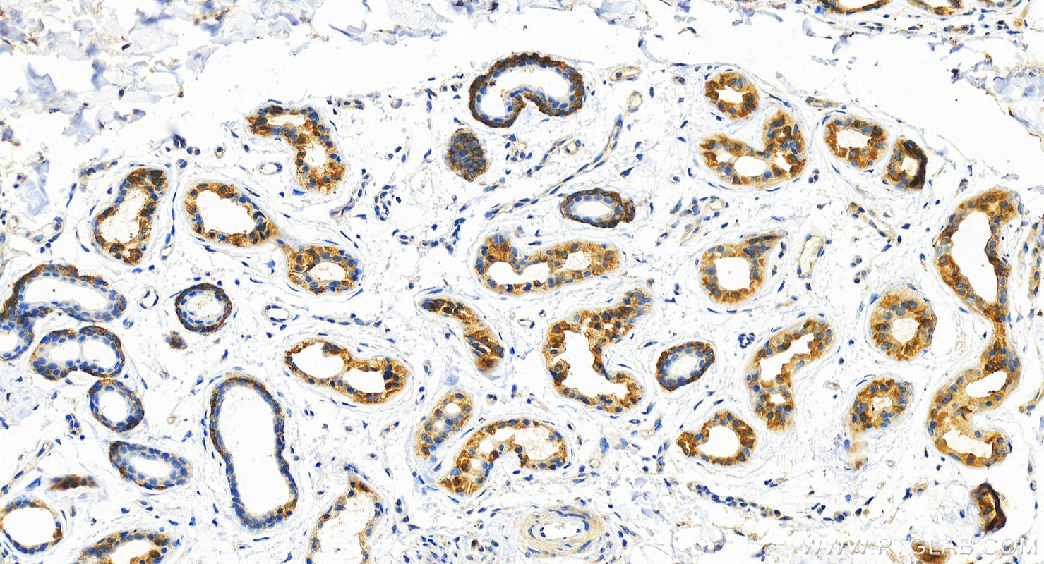 Immunohistochemistry (IHC) staining of human bowen disease using AP1M2 Polyclonal antibody (10618-1-AP)