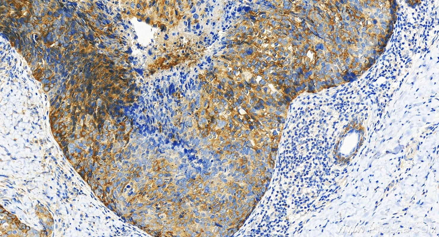 Immunohistochemistry (IHC) staining of human bowen disease using AP1M2 Polyclonal antibody (10618-1-AP)