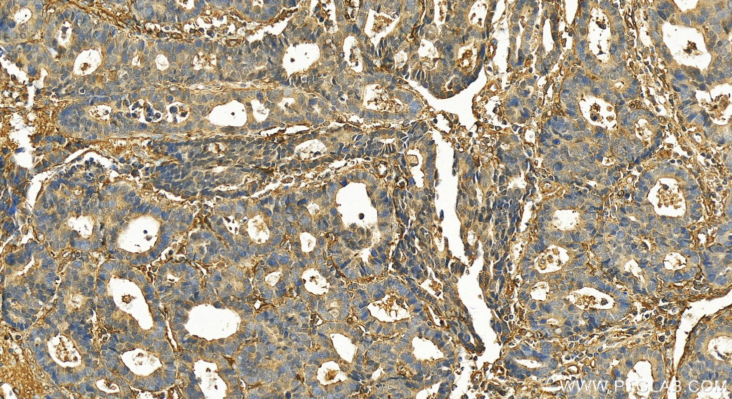 Immunohistochemistry (IHC) staining of human stomach cancer tissue using AP2A1 Polyclonal antibody (30030-1-AP)