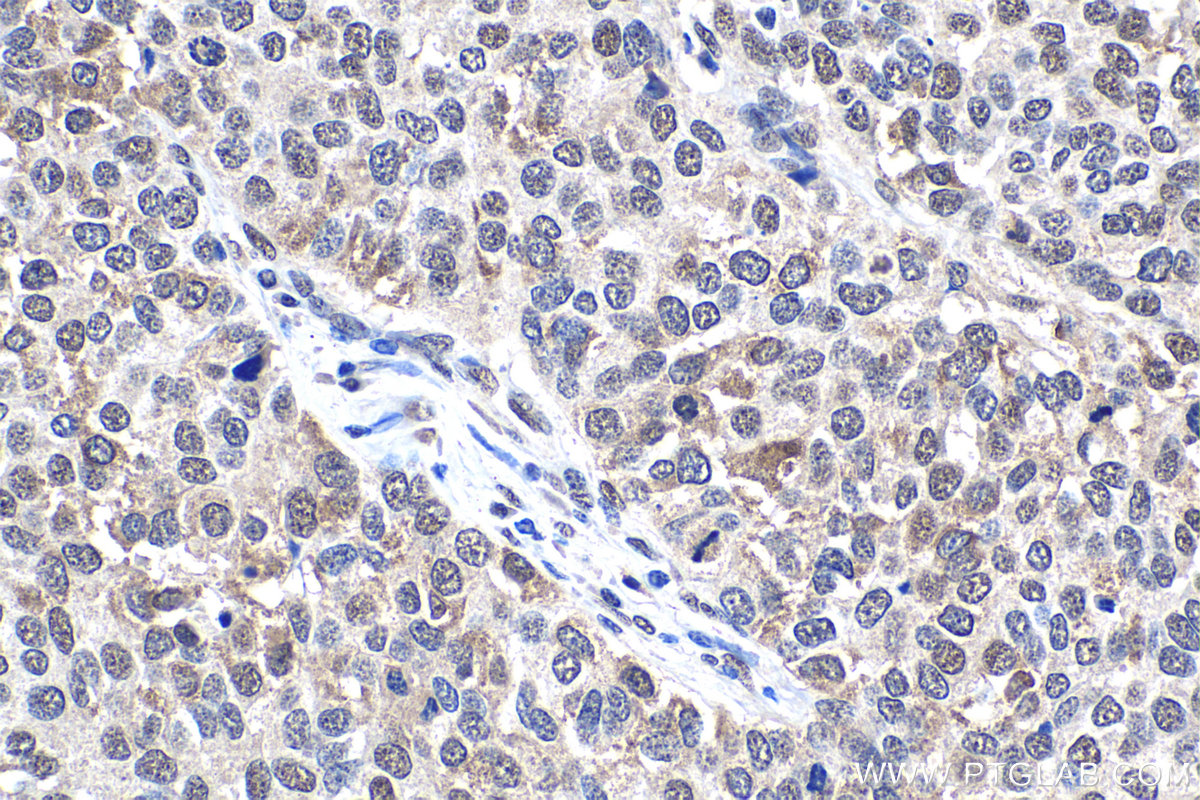 Immunohistochemistry (IHC) staining of human stomach cancer tissue using APEX1 Polyclonal antibody (10203-1-AP)