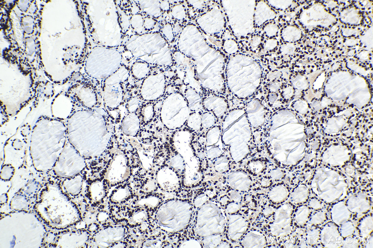 Immunohistochemistry (IHC) staining of human thyroid cancer tissue using APEX1 Polyclonal antibody (10203-1-AP)