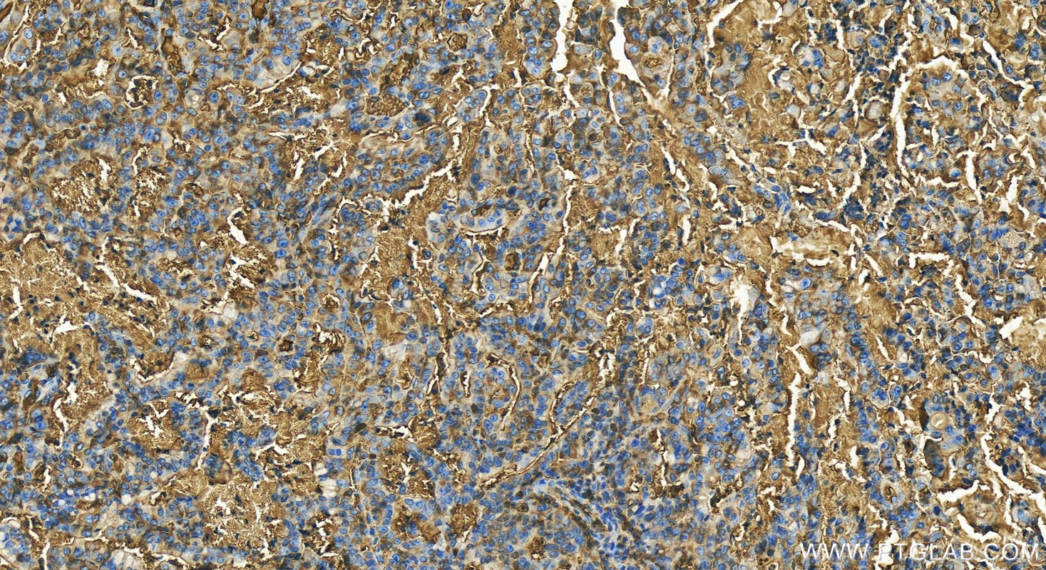 Immunohistochemistry (IHC) staining of human stomach cancer tissue using Apolipoprotein AI Recombinant antibody (83504-1-RR)