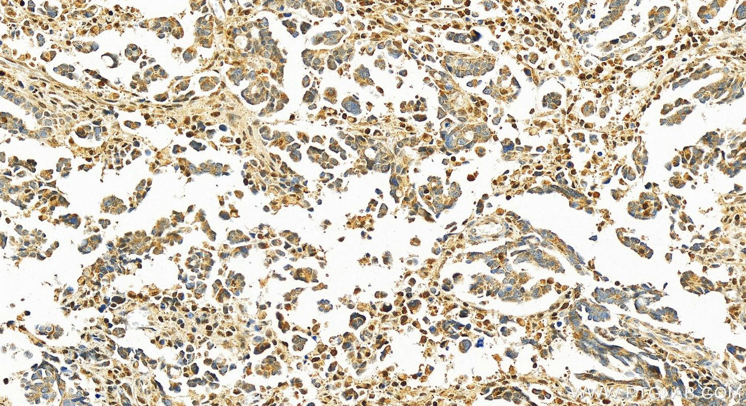 Immunohistochemistry (IHC) staining of human ovary cancer tissue using APOBEC3C Polyclonal antibody (10591-1-AP)