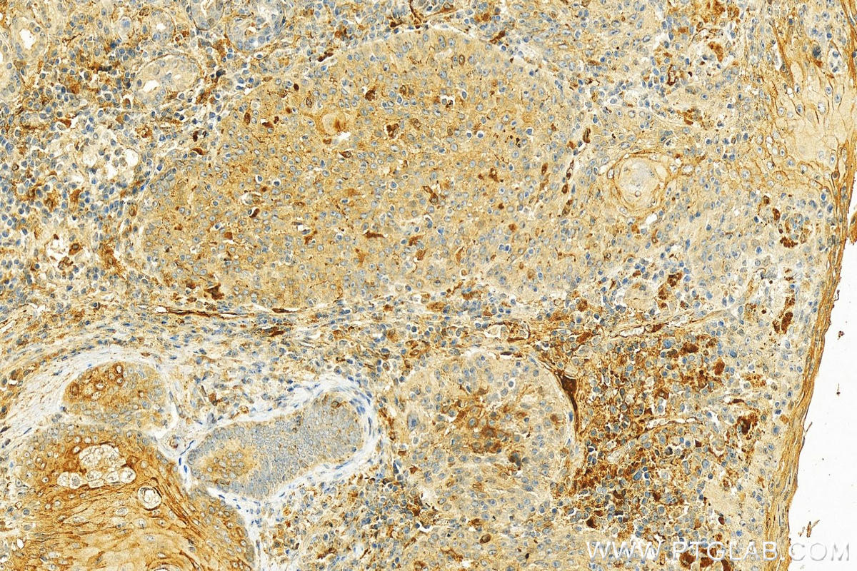 Immunohistochemistry (IHC) staining of human skin cancer tissue using APOE Polyclonal antibody (18254-1-AP)