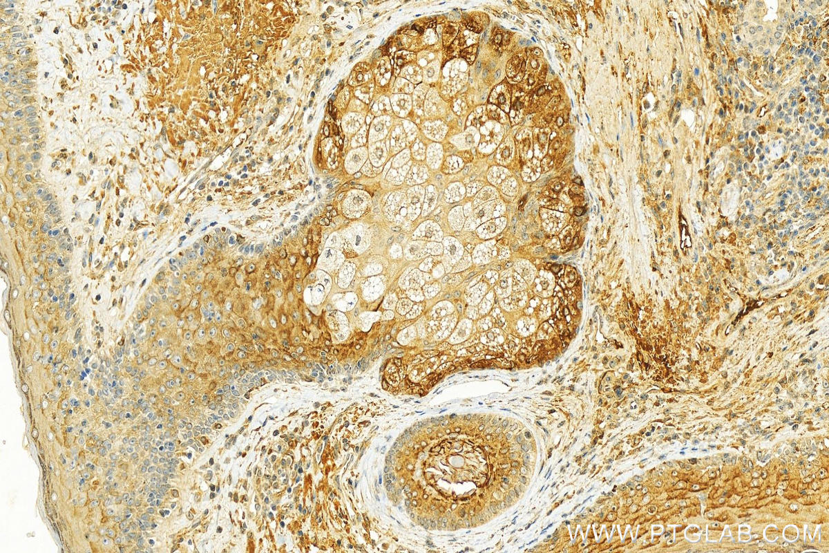 Immunohistochemistry (IHC) staining of human skin cancer tissue using APOE Polyclonal antibody (18254-1-AP)