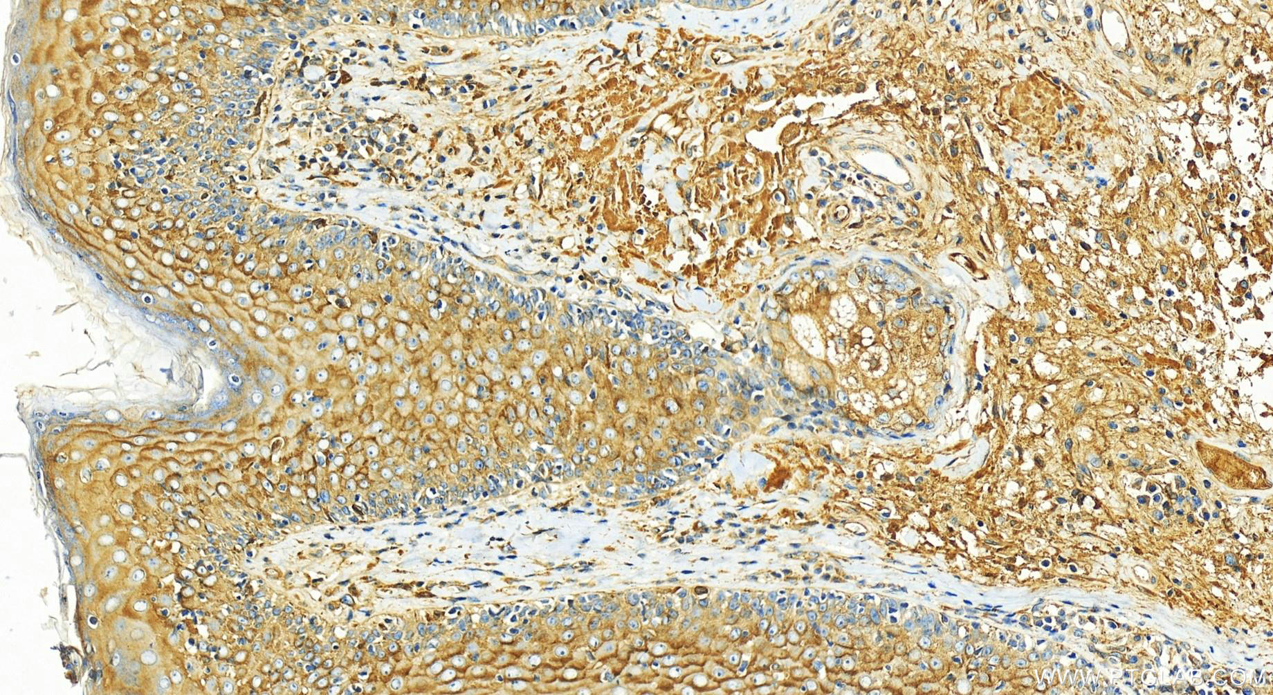 Immunohistochemistry (IHC) staining of human skin cancer tissue using APOE Polyclonal antibody (30535-1-AP)