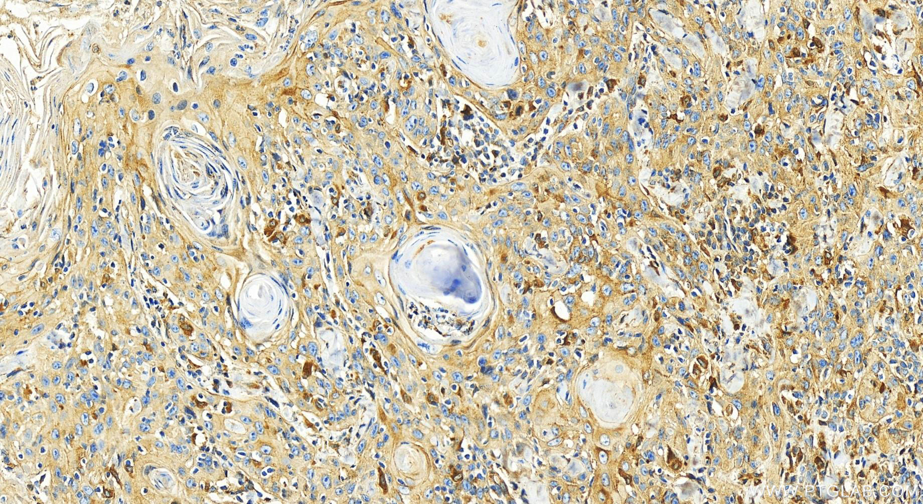 Immunohistochemistry (IHC) staining of human skin cancer tissue using APOE Polyclonal antibody (30535-1-AP)