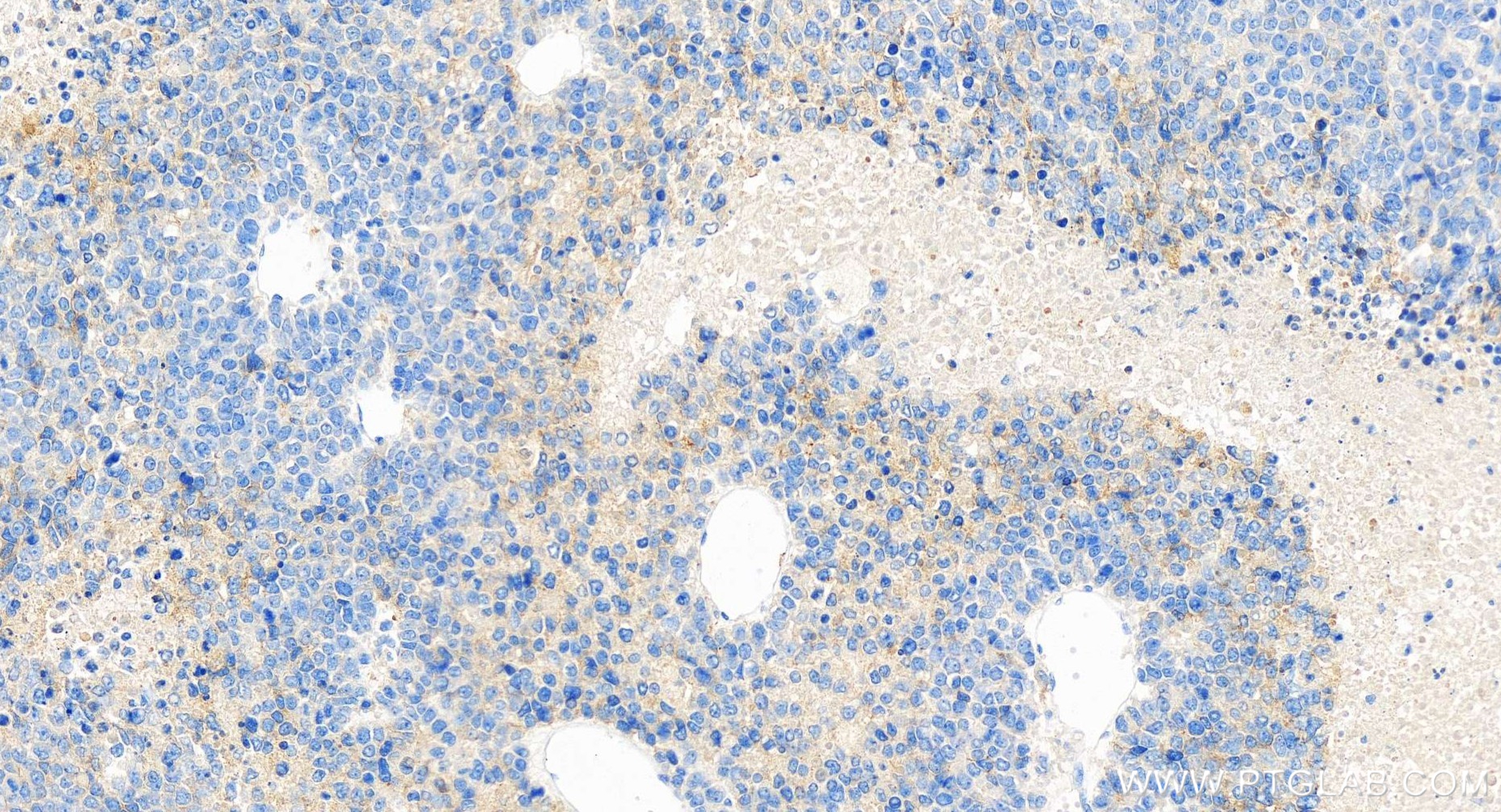 Immunohistochemistry (IHC) staining of human liver cancer tissue using APOH Recombinant antibody (84943-2-RR)