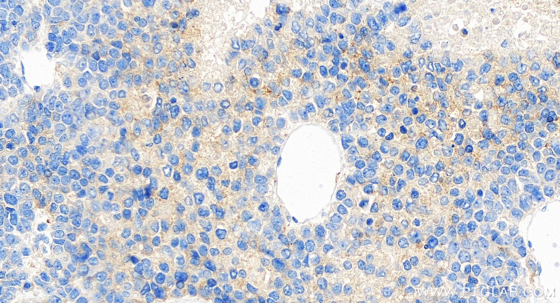Immunohistochemistry (IHC) staining of human liver cancer tissue using APOH Recombinant antibody (84943-2-RR)