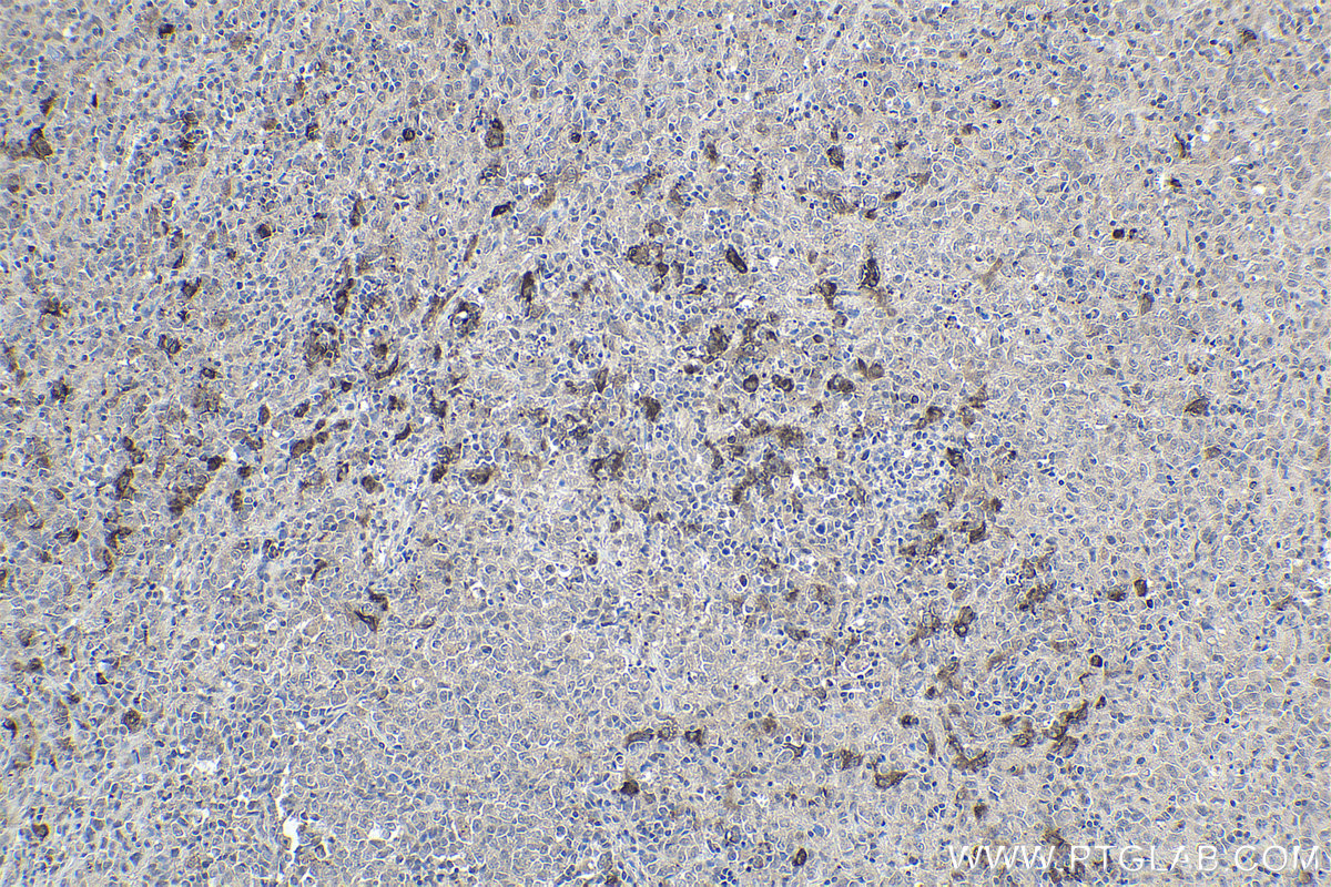 Immunohistochemistry (IHC) staining of human malignant melanoma tissue using APPL2 Polyclonal antibody (14294-1-AP)