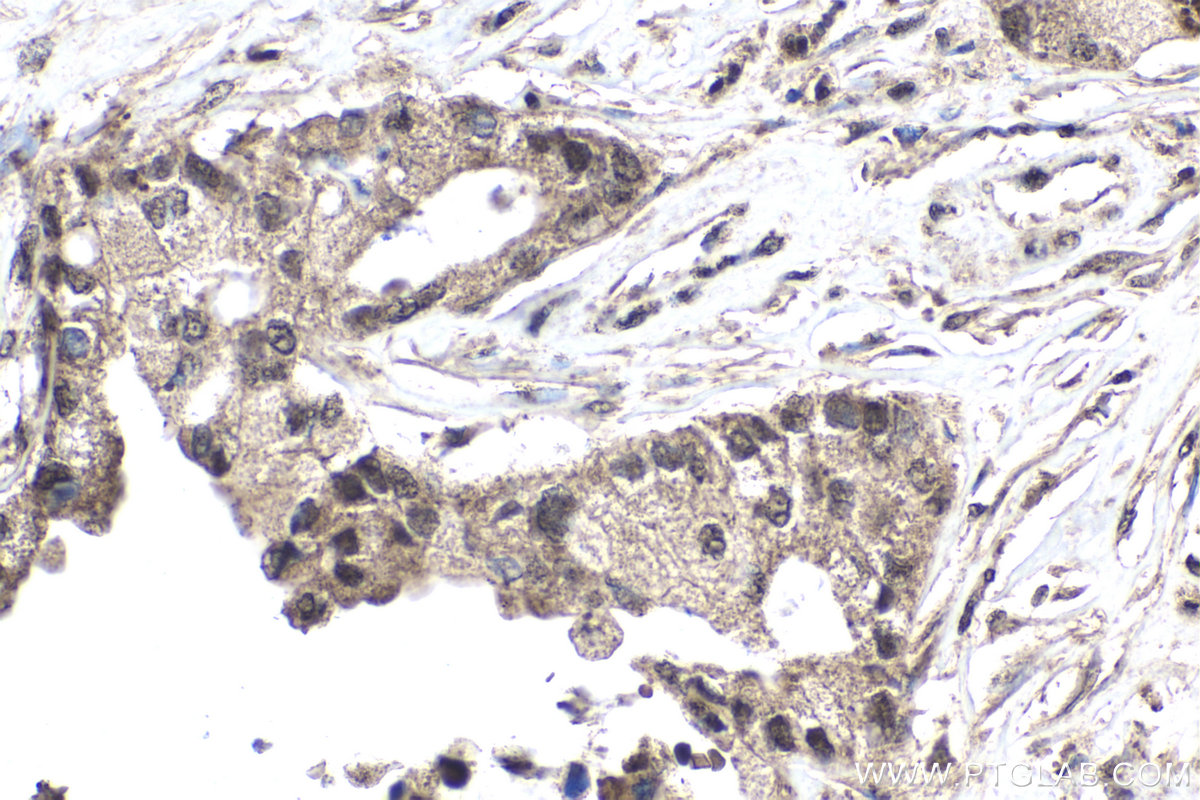 Immunohistochemistry (IHC) staining of human pancreas cancer tissue using APPL2 Polyclonal antibody (14294-1-AP)