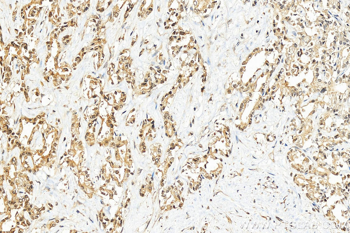 Immunohistochemistry (IHC) staining of human intrahepatic cholangiocarcinoma tissue using TNFSF13 Polyclonal antibody (10680-1-AP)