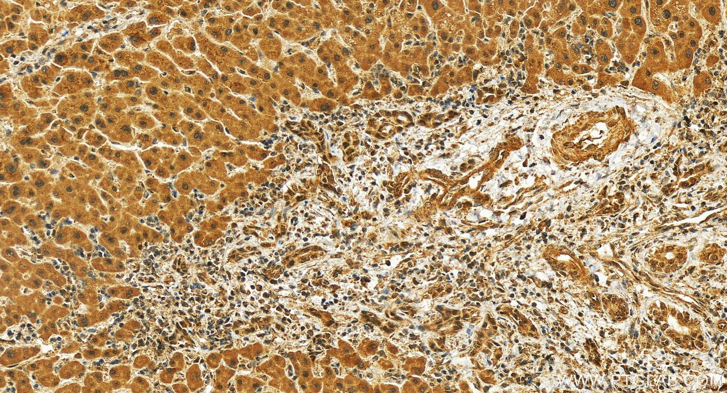 Immunohistochemistry (IHC) staining of human intrahepatic cholangiocarcinoma tissue using APTX Polyclonal antibody (26747-1-AP)