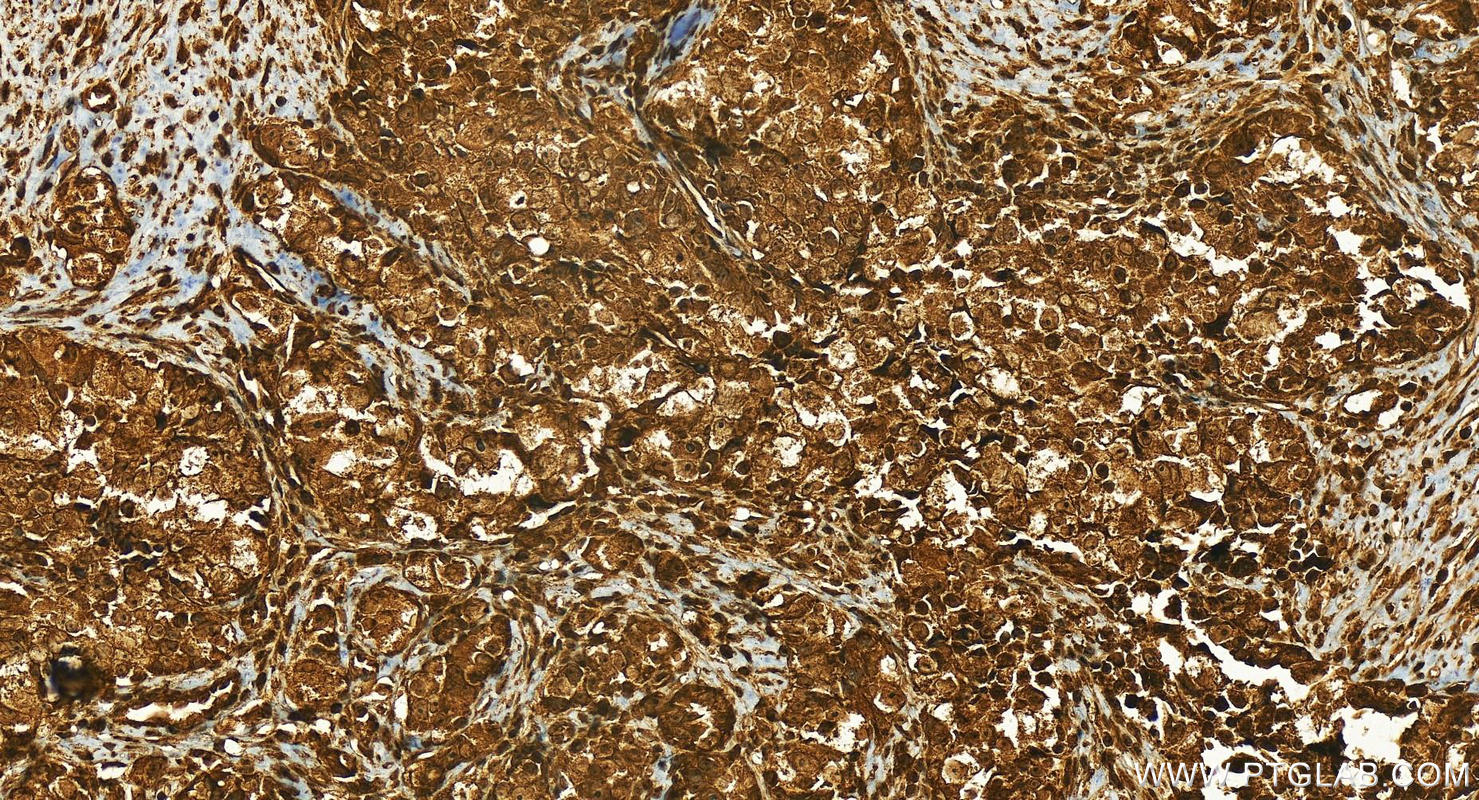 Immunohistochemistry (IHC) staining of human ovary cancer tissue using APTX Polyclonal antibody (26747-1-AP)