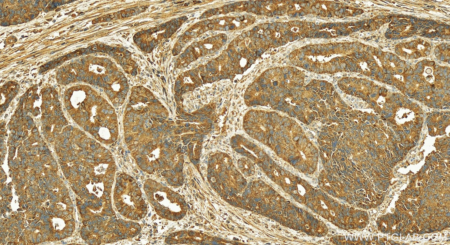 Immunohistochemistry (IHC) staining of human stomach cancer tissue using Amphiregulin Polyclonal antibody (16036-1-AP)