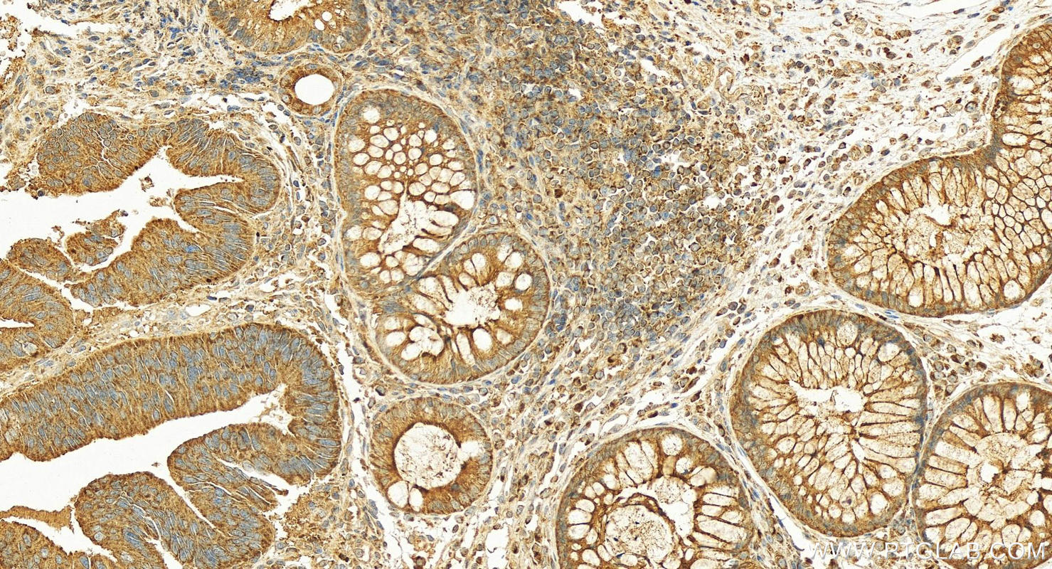 Immunohistochemistry (IHC) staining of human colon cancer tissue using ARF1 Polyclonal antibody (20226-1-AP)