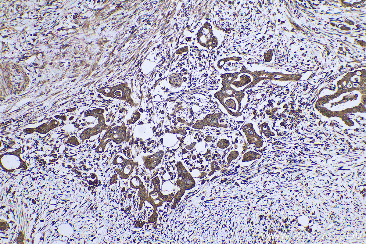 Immunohistochemistry (IHC) staining of human pancreas cancer tissue using ARF4 Monoclonal antibody (68204-1-Ig)