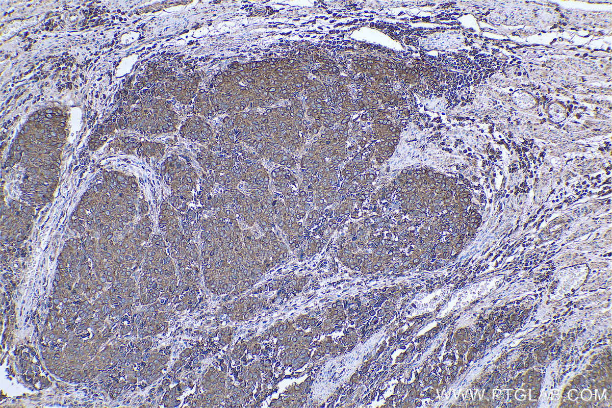 Immunohistochemistry (IHC) staining of human stomach cancer tissue using ARF4 Monoclonal antibody (68204-1-Ig)