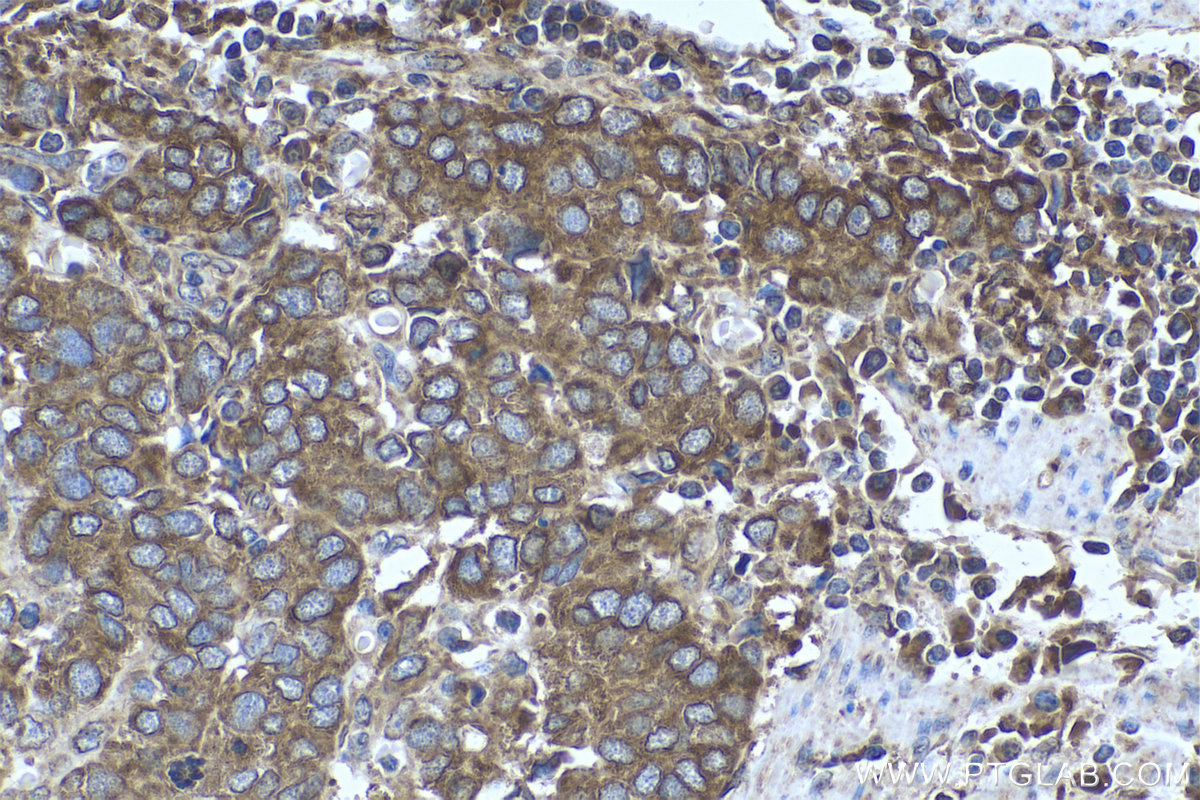 Immunohistochemistry (IHC) staining of human stomach cancer tissue using ARF4 Monoclonal antibody (68204-1-Ig)