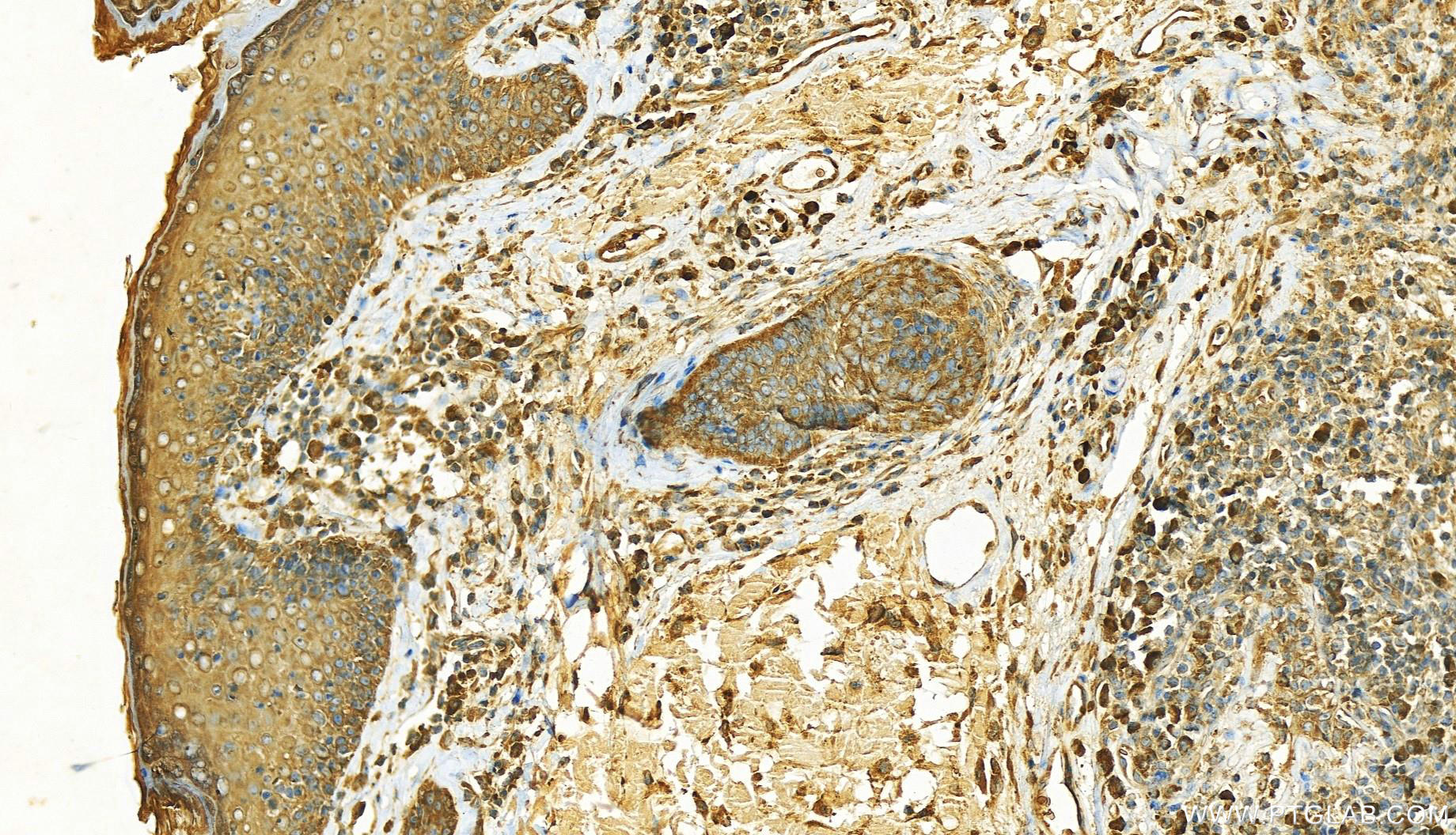 Immunohistochemistry (IHC) staining of human skin cancer tissue using ARF5-Specific Polyclonal antibody (20227-1-AP)