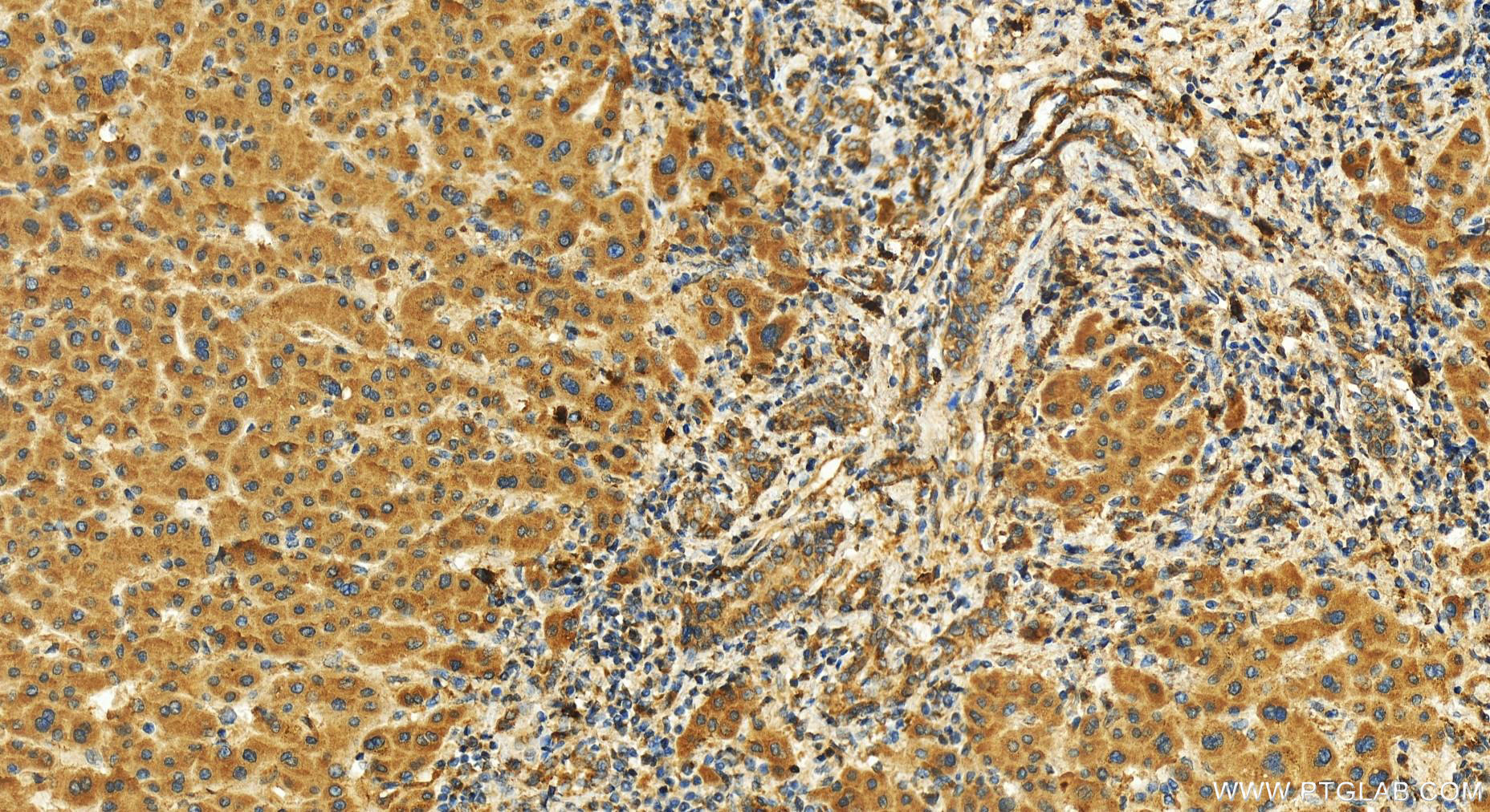 Immunohistochemistry (IHC) staining of human intrahepatic cholangiocarcinoma tissue using ARFRP1 Polyclonal antibody (17712-1-AP)