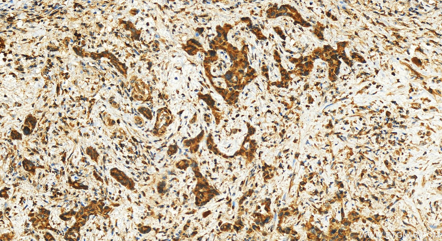 Immunohistochemistry (IHC) staining of human intrahepatic cholangiocarcinoma tissue using ARFRP1 Polyclonal antibody (17712-1-AP)