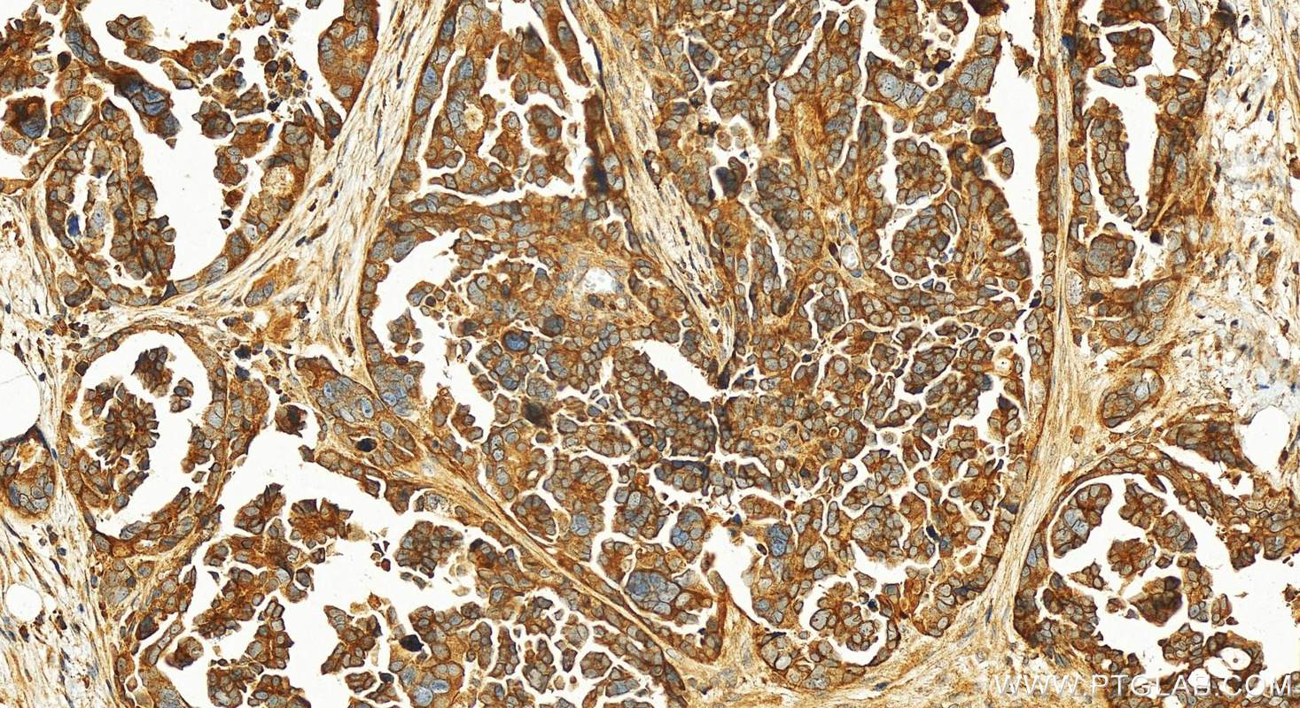 Immunohistochemistry (IHC) staining of human ovary cancer tissue using ARHGAP21 Polyclonal antibody (22183-1-AP)