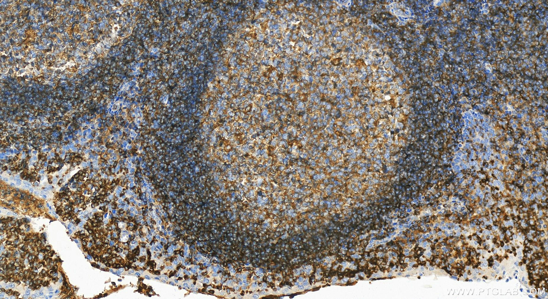 Immunohistochemistry (IHC) staining of human tonsillitis tissue using ARHGAP25 Polyclonal antibody (14349-1-AP)