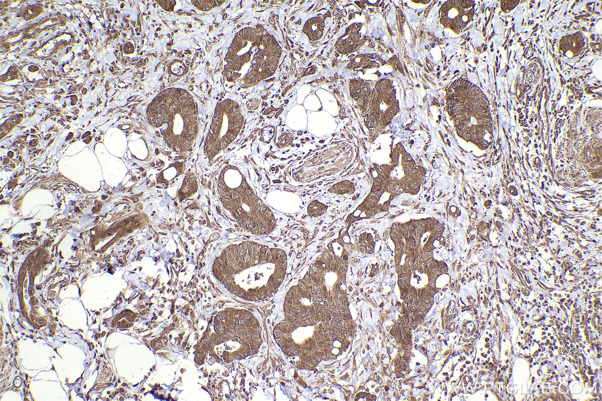 Immunohistochemistry (IHC) staining of human rectal cancer tissue using ARHGEF7 Polyclonal antibody (14092-1-AP)