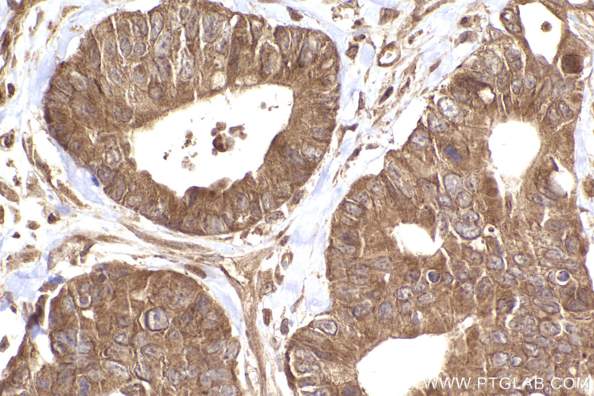 Immunohistochemistry (IHC) staining of human rectal cancer tissue using ARHGEF7 Polyclonal antibody (14092-1-AP)