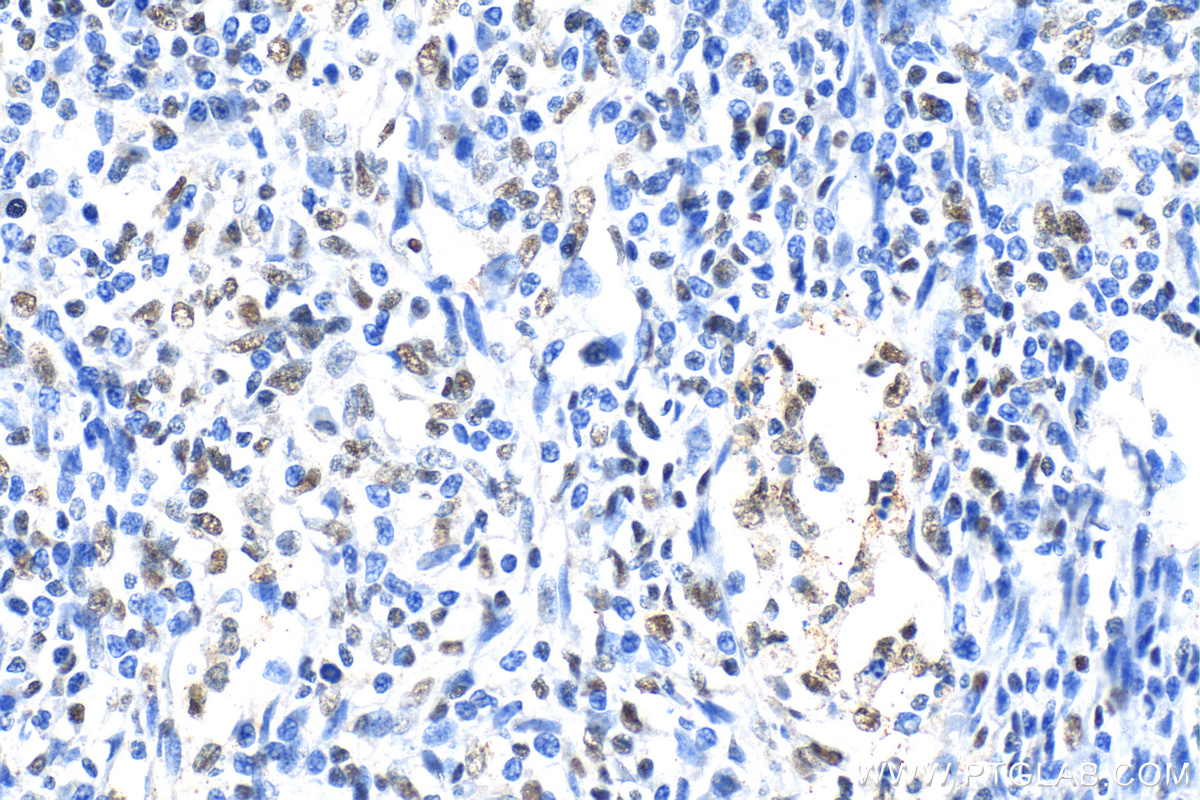 Immunohistochemistry (IHC) staining of human endometrial cancer tissue using ARID1A Polyclonal antibody (30304-1-AP)