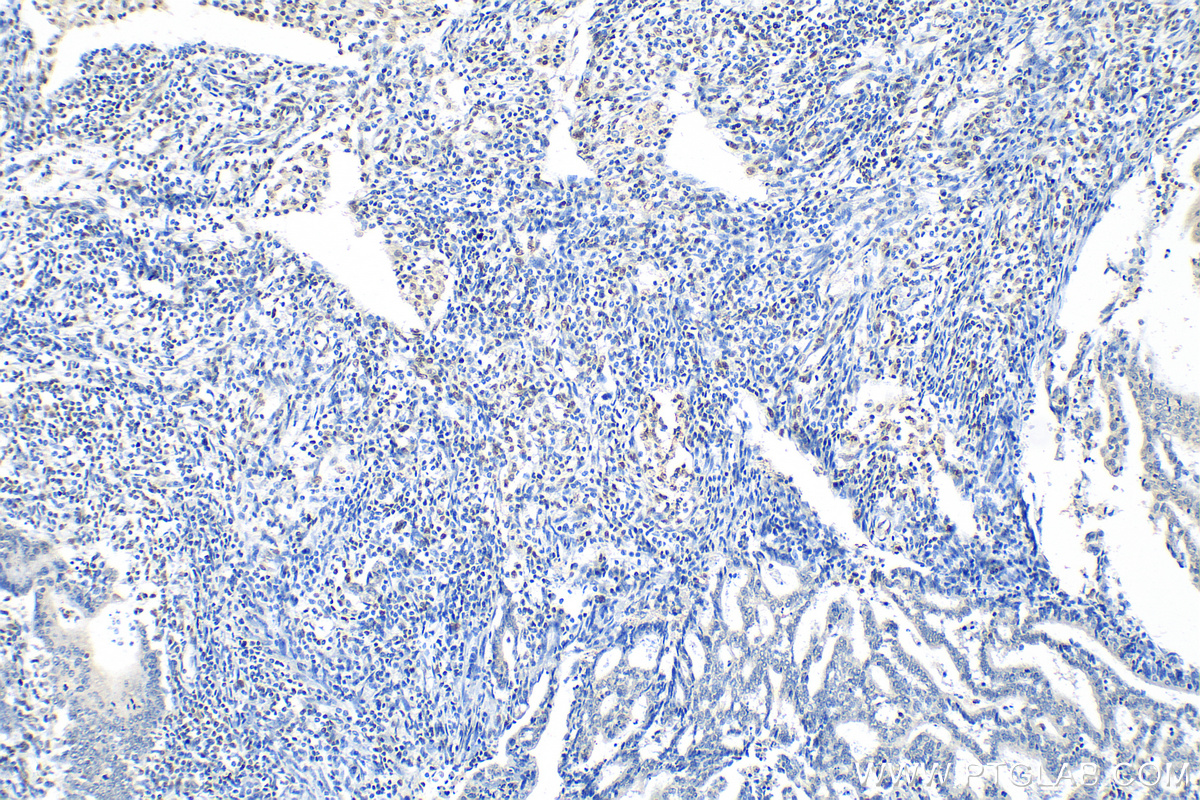 Immunohistochemistry (IHC) staining of human endometrial cancer tissue using ARID1A Polyclonal antibody (30304-1-AP)