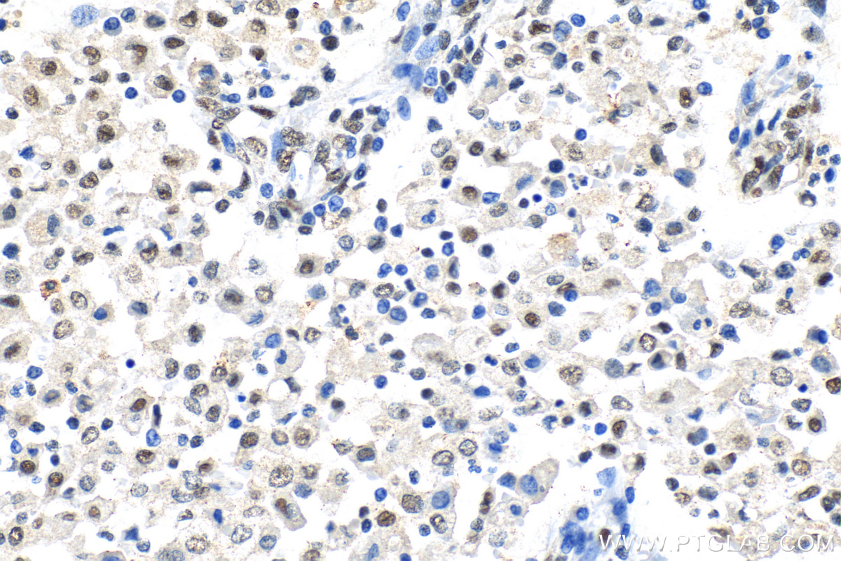 Immunohistochemistry (IHC) staining of human endometrial cancer tissue using ARID1A Polyclonal antibody (30304-1-AP)