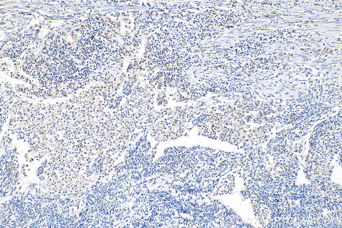 Immunohistochemistry (IHC) staining of human endometrial cancer tissue using ARID1A Polyclonal antibody (30304-1-AP)