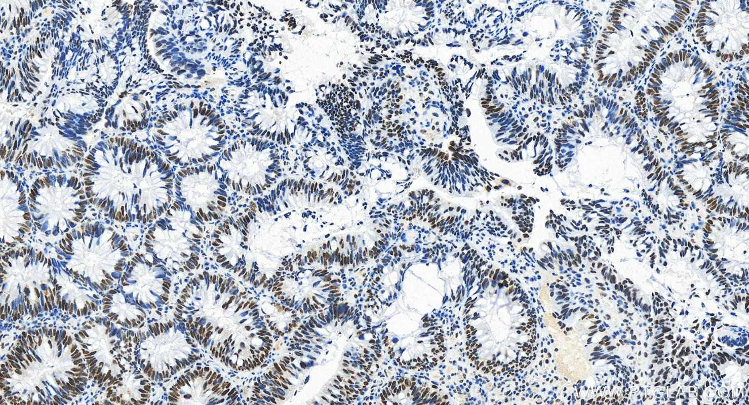 Immunohistochemistry (IHC) staining of human colon cancer tissue using ARID1A Recombinant antibody (83733-3-RR)