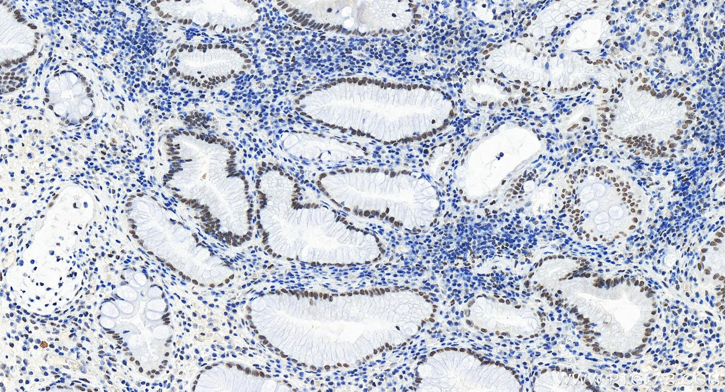 Immunohistochemistry (IHC) staining of human stomach cancer tissue using ARID1A Recombinant antibody (83733-3-RR)