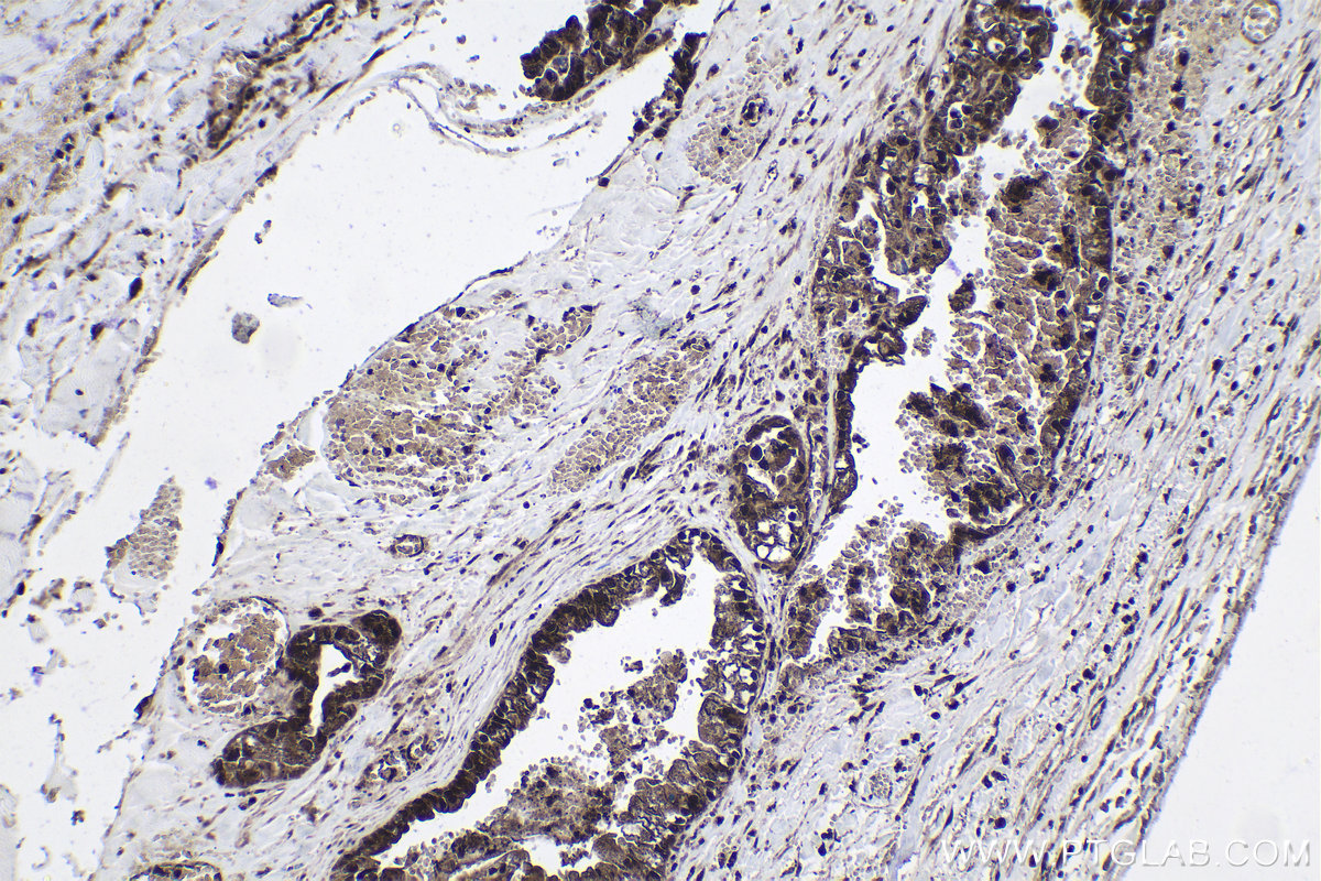 Immunohistochemistry (IHC) staining of human pancreas cancer tissue using ARID4B Polyclonal antibody (24499-1-AP)