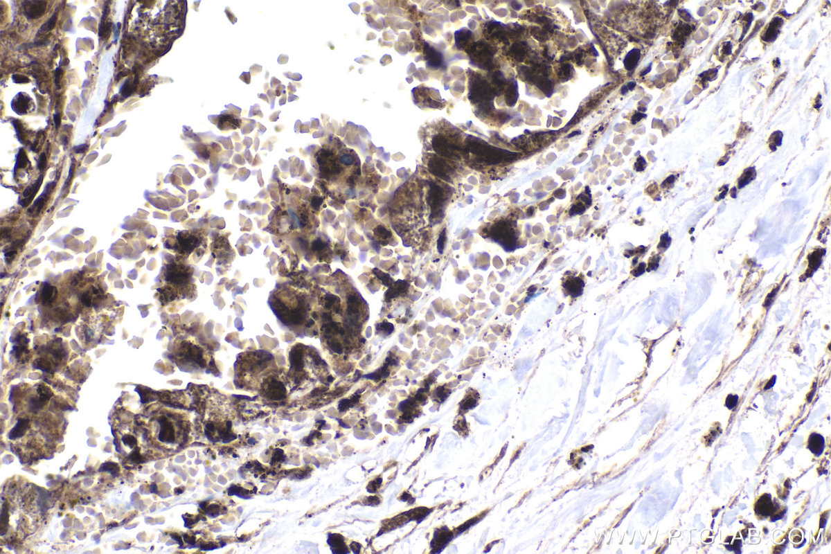 Immunohistochemistry (IHC) staining of human pancreas cancer tissue using ARID4B Polyclonal antibody (24499-1-AP)