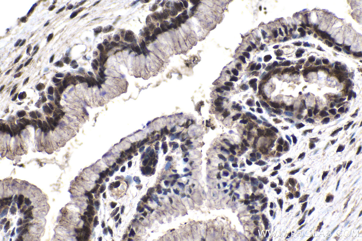 Immunohistochemistry (IHC) staining of human cervical cancer tissue using ARID4B Polyclonal antibody (24499-1-AP)