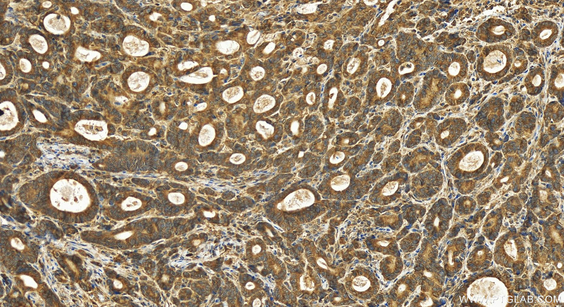 Immunohistochemistry (IHC) staining of human stomach cancer tissue using ARL1 Polyclonal antibody (16012-1-AP)