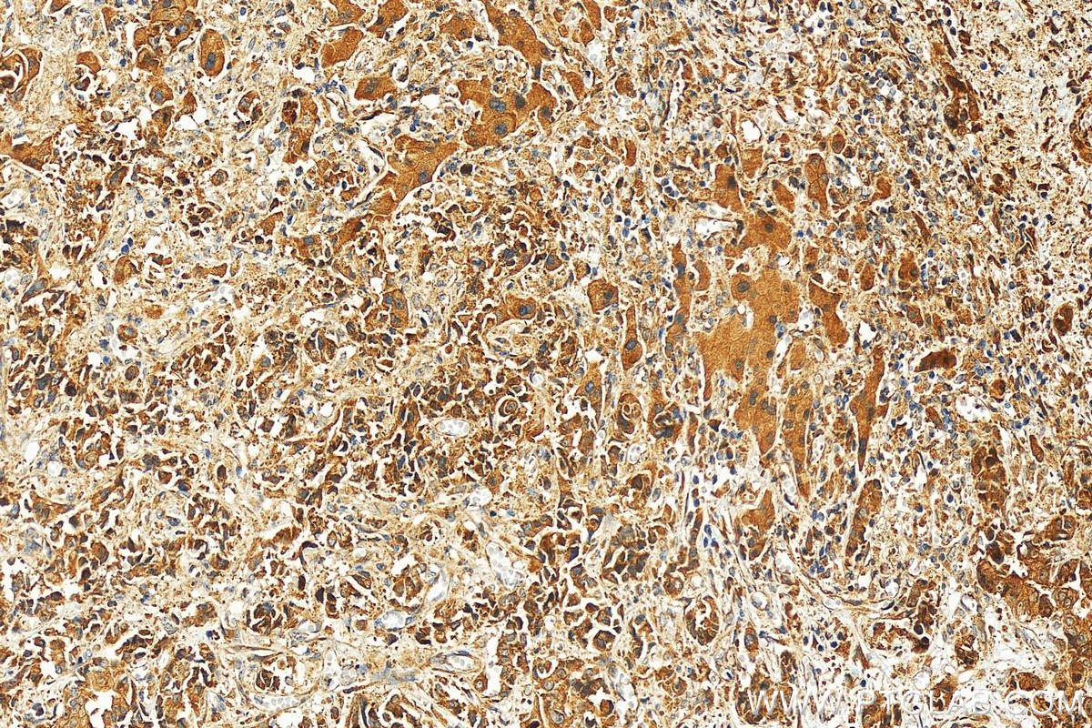 Immunohistochemistry (IHC) staining of human intrahepatic cholangiocarcinoma tissue using ARL5B Polyclonal antibody (11694-1-AP)