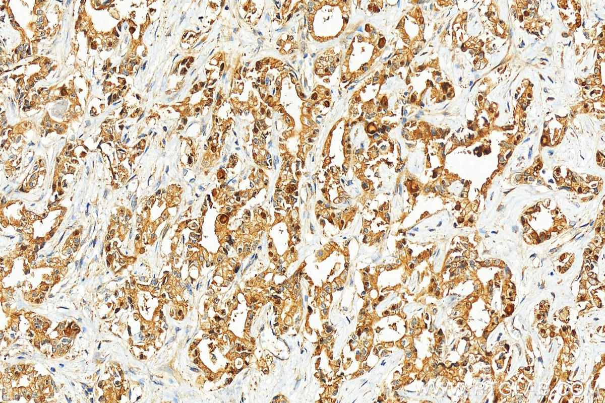 Immunohistochemistry (IHC) staining of human intrahepatic cholangiocarcinoma tissue using ARL5B Polyclonal antibody (11694-1-AP)