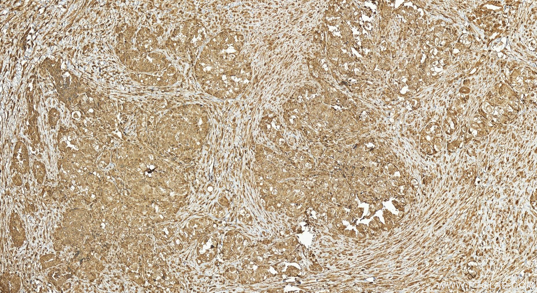 Immunohistochemistry (IHC) staining of human ovary cancer tissue using ARMCX3 Polyclonal antibody (25705-1-AP)