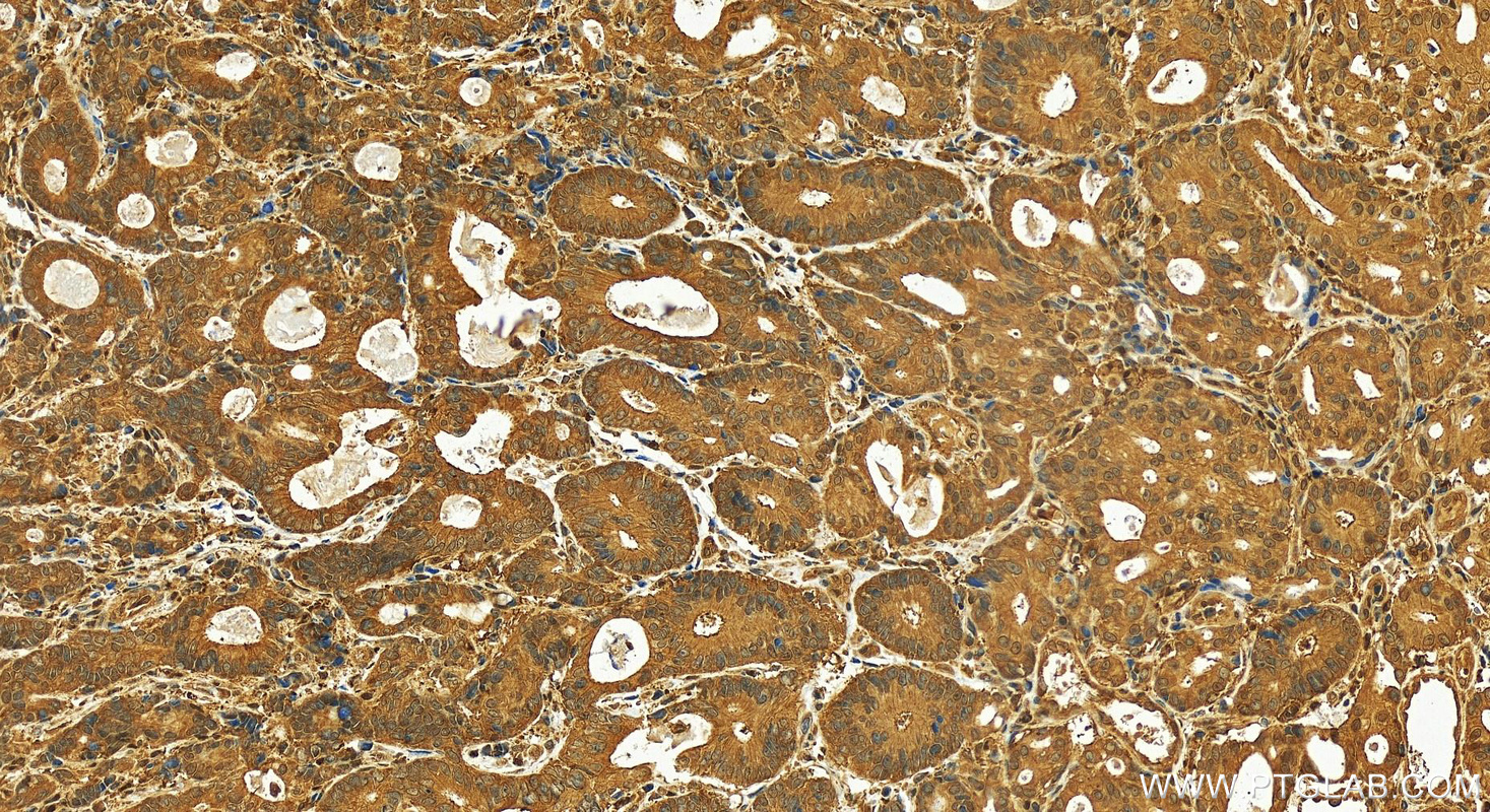 Immunohistochemistry (IHC) staining of human stomach cancer tissue using ASB9 Polyclonal antibody (11952-1-AP)