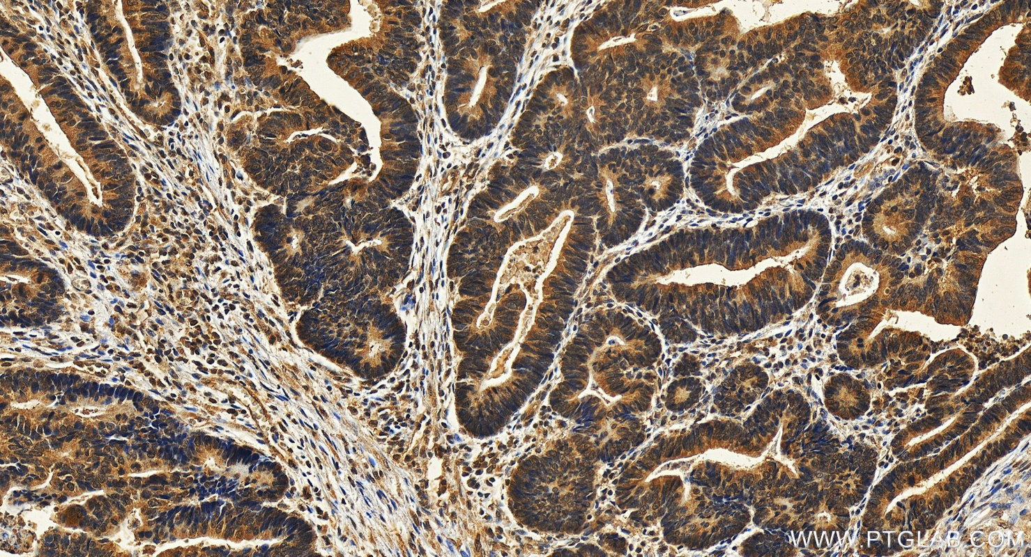 Immunohistochemistry (IHC) staining of human colon cancer tissue using ASC/TMS1 Monoclonal antibody (67494-1-Ig)