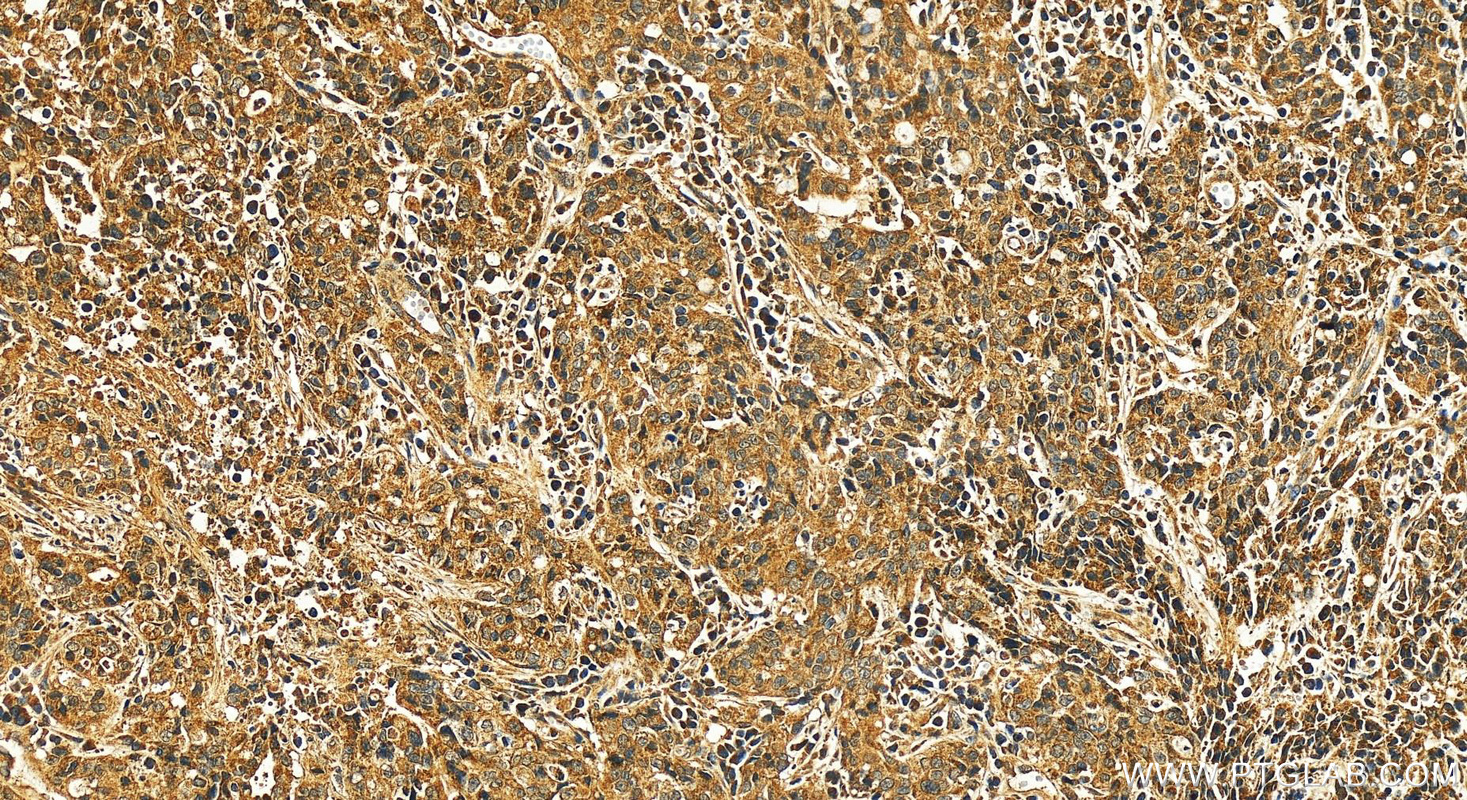 Immunohistochemistry (IHC) staining of human stomach cancer tissue using ASCL2 Polyclonal antibody (21368-1-AP)