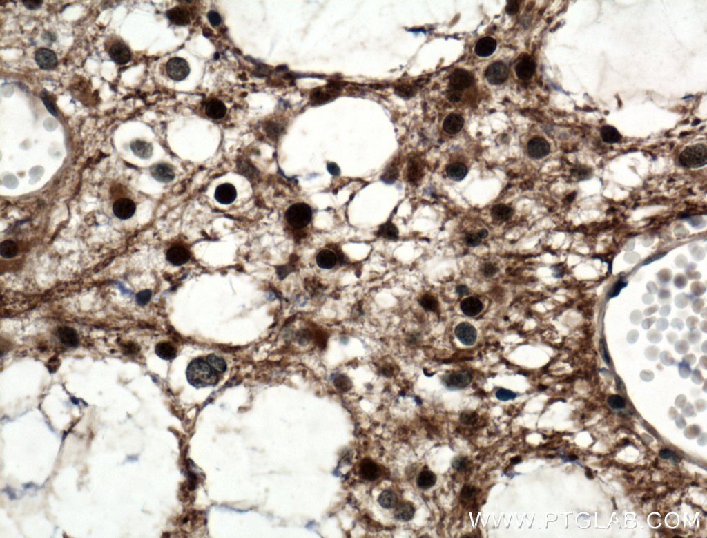 Immunohistochemistry (IHC) staining of human gliomas tissue using ASRGL1 Polyclonal antibody (11400-1-AP)