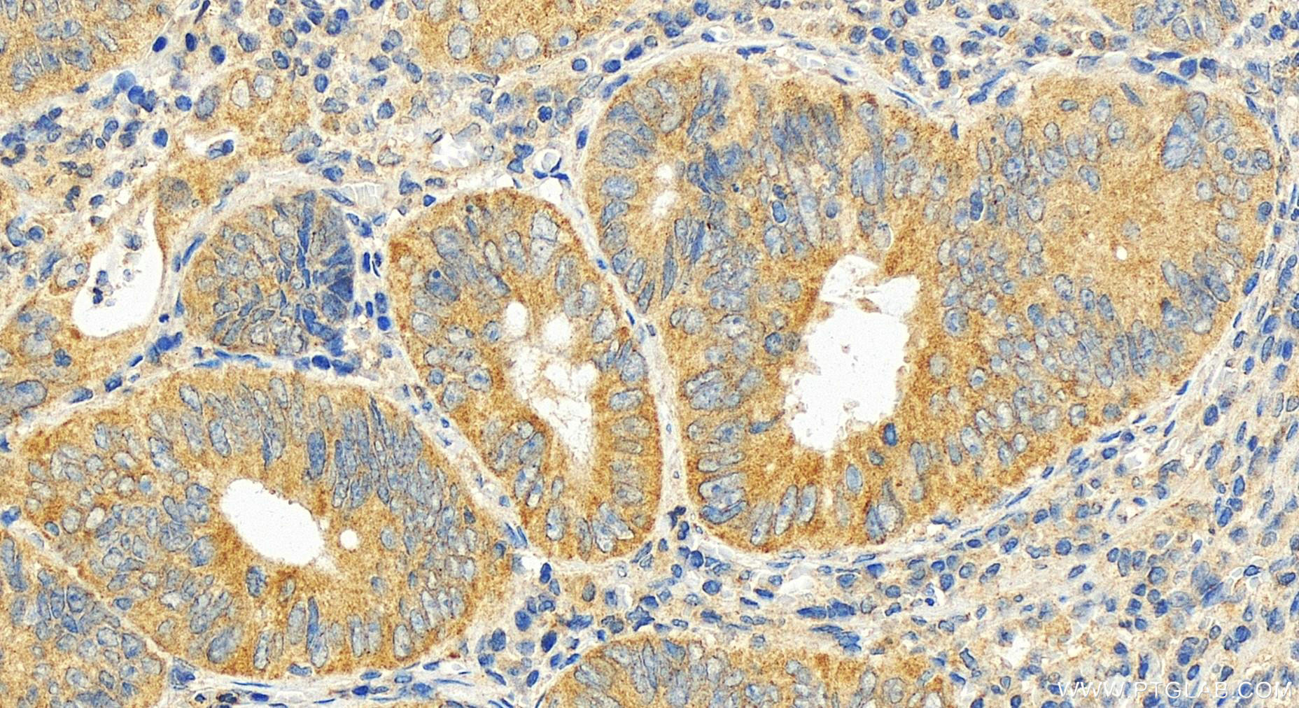 Immunohistochemistry (IHC) staining of human colon cancer tissue using ATAD1 Polyclonal antibody (16882-1-AP)