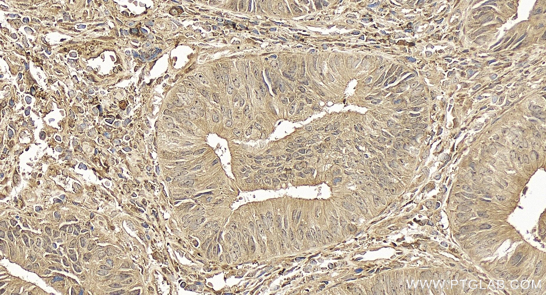 Immunohistochemistry (IHC) staining of human colon cancer tissue using ATF4 Recombinant antibody (81798-1-RR)