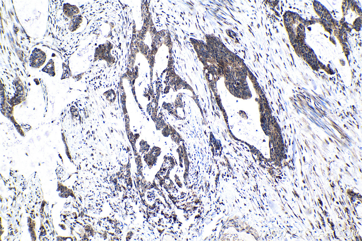 Immunohistochemistry (IHC) staining of human urothelial carcinoma tissue using ATF7 Polyclonal antibody (29770-1-AP)